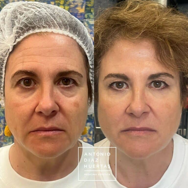 full face 4 _ ojeras