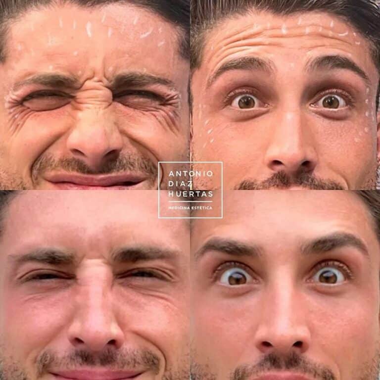 arrugas tercio superior