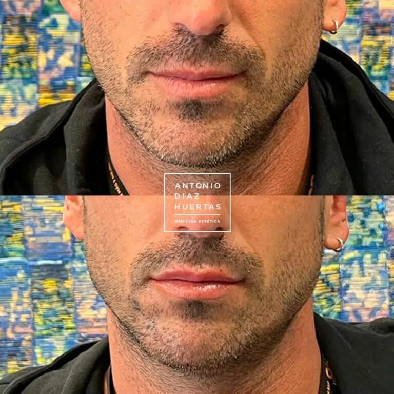 marcacion de mandibular