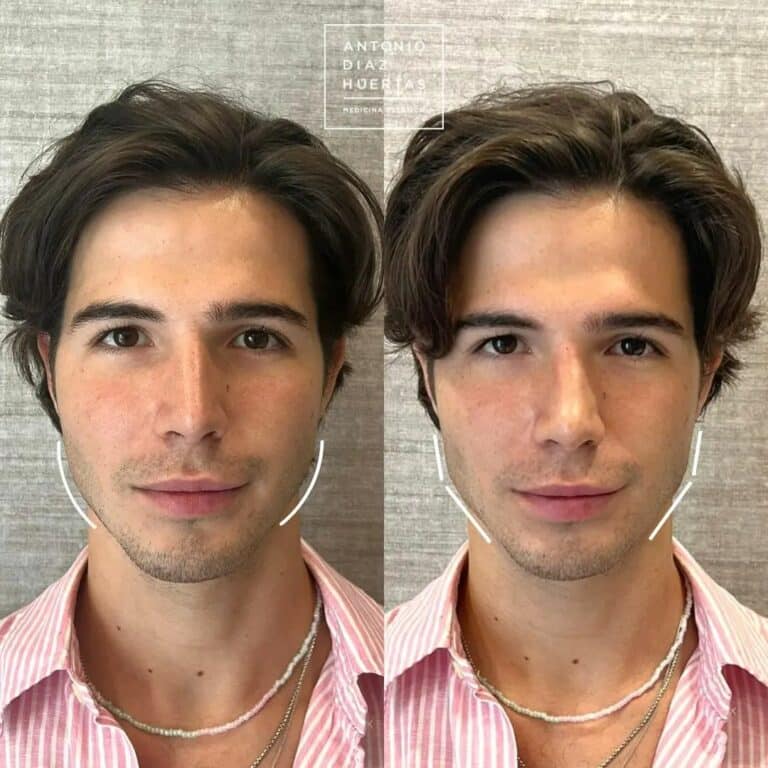 marcacion mandibular hombre