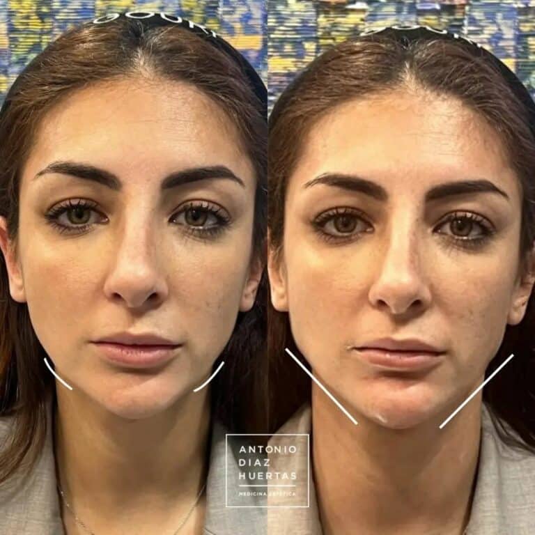 marcacion mandibular mujer