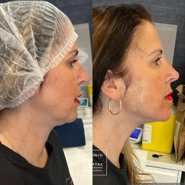 marcacion mandibular mujeres