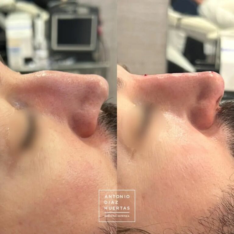 rinomodelacion-acido