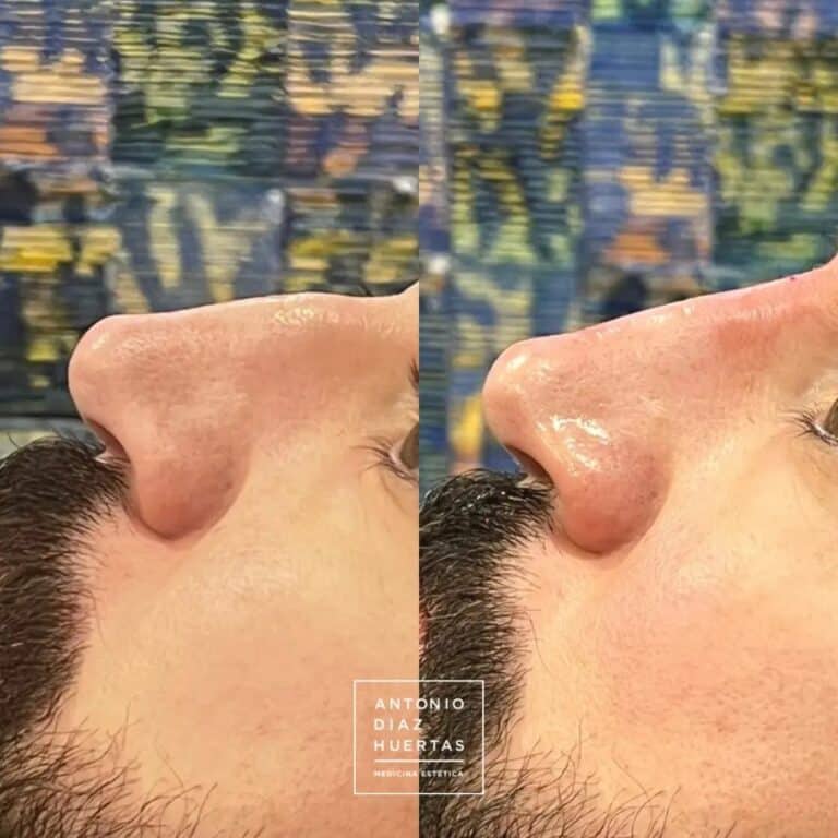 rinomodelacion-acido2