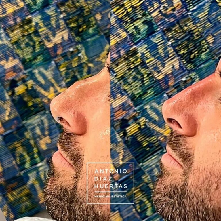 rinomodelacion hombre