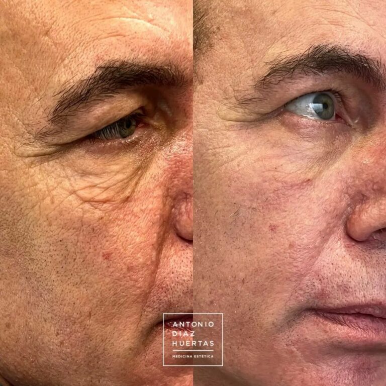 blefaroplastia inferior sin cirugia