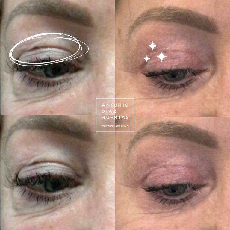 blefaroplastia superior sin cirugia