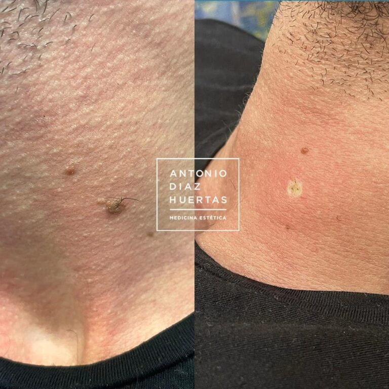 lesion benigna mancha plasmage